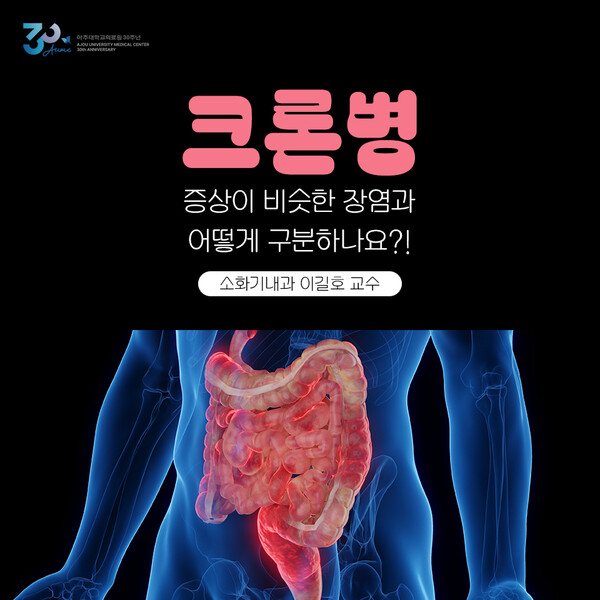 Read more about the article 크론병, 증상이 비슷한 장염과 어떻게 구분하나요?